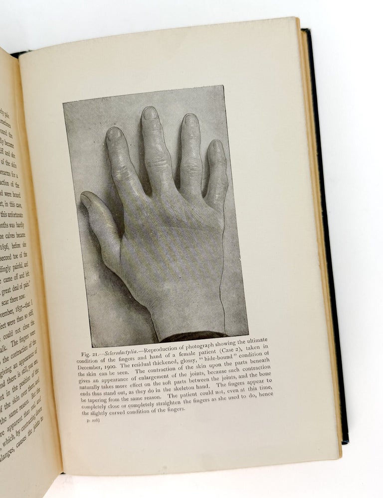 LECTURES ON HYSTERIA AND ALLIED VASO-MOTOR CONDITIONS