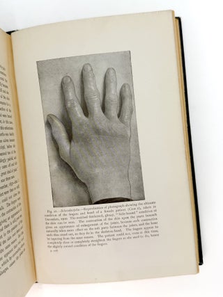 LECTURES ON HYSTERIA AND ALLIED VASO-MOTOR CONDITIONS. Thomas D. Savill.